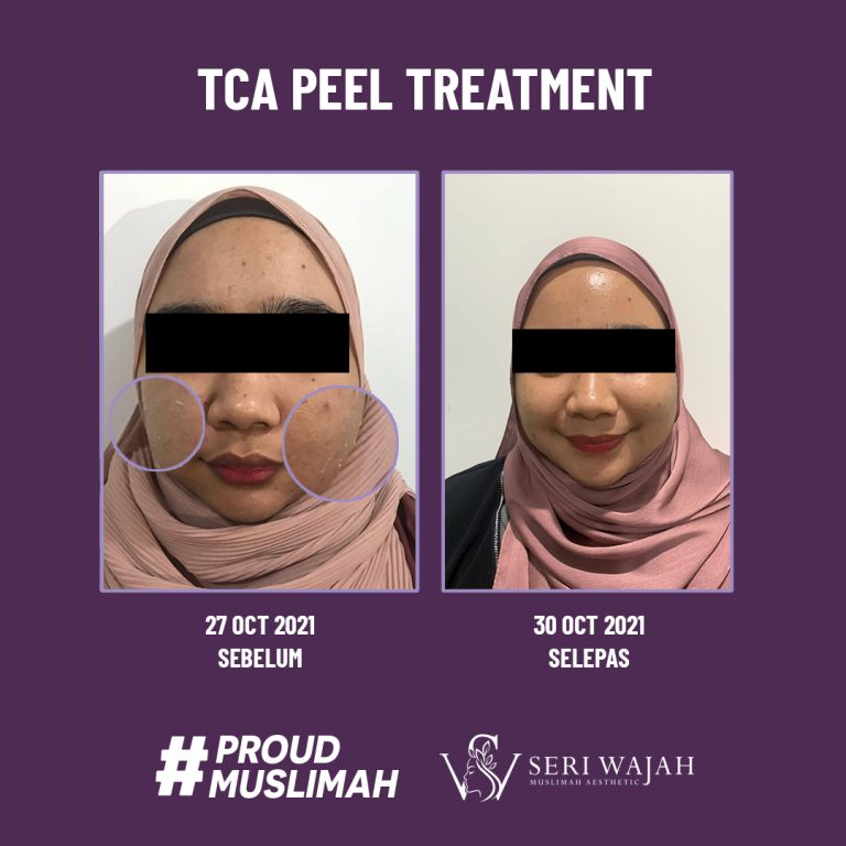 TCA PEEL TREATMENT 1