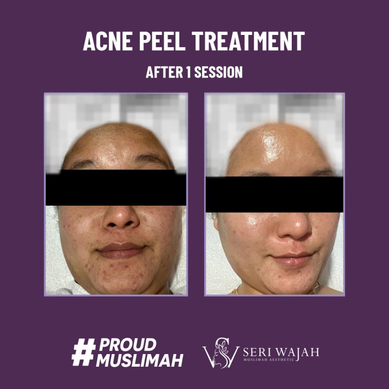 acne peel