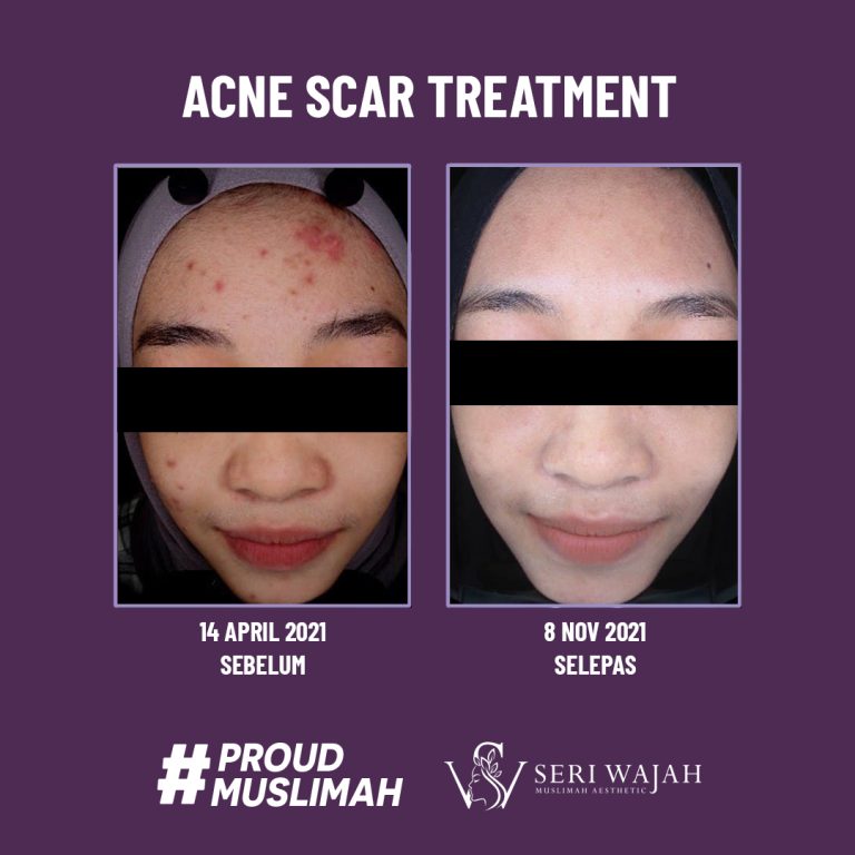 acne scar treatment