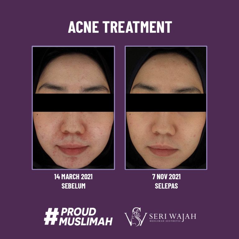 acne treatment 1