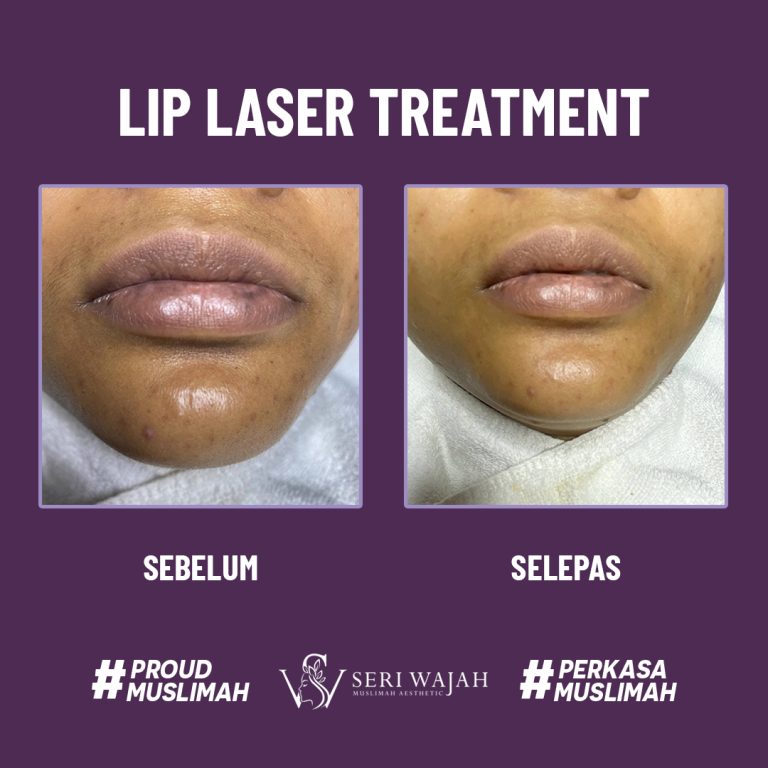 lip laser treatment