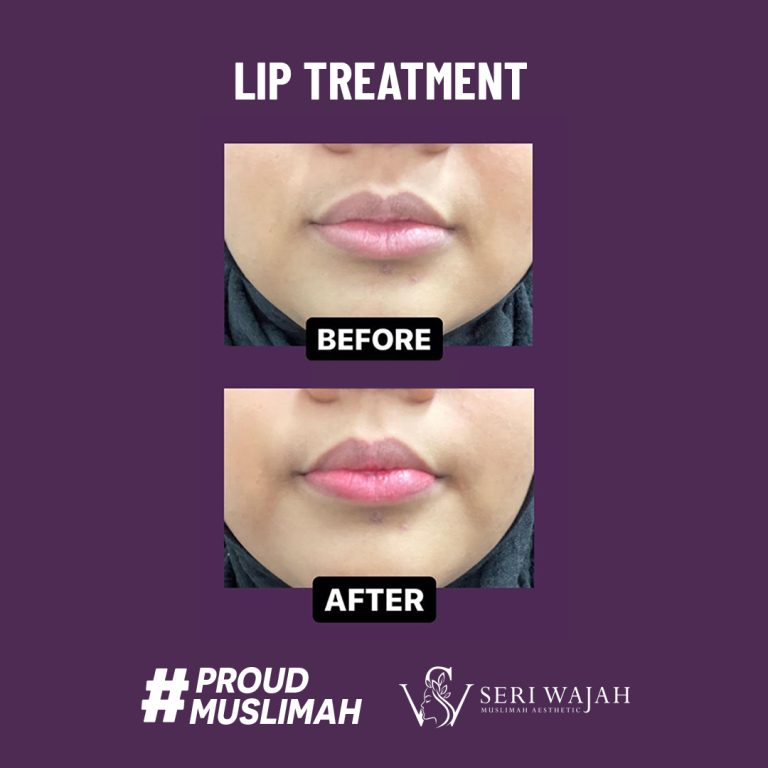 lip treatment