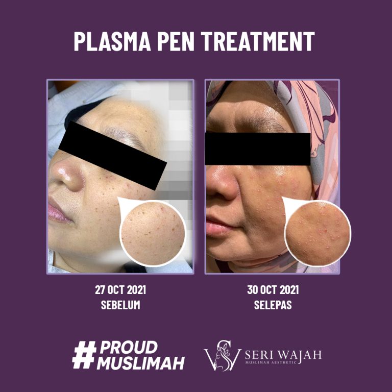 plasma pen treatment 2