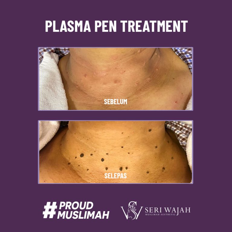 plasma pen treatment