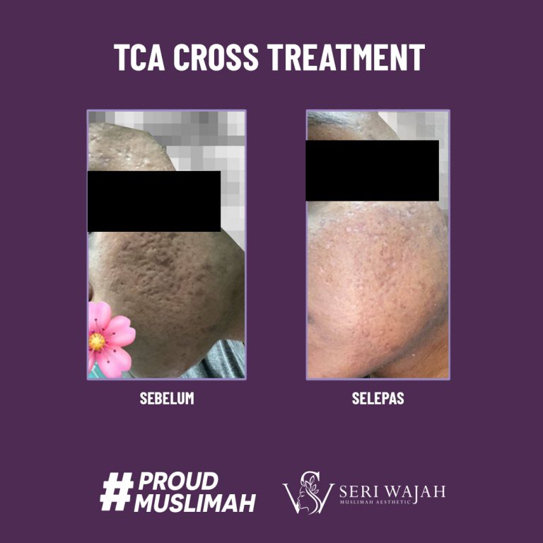 tca cross treatment